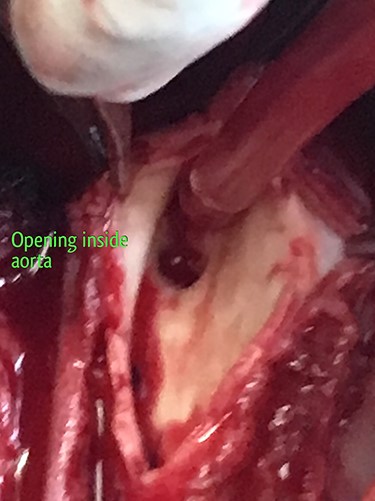 2 × 2 cm opening of the fistula inside the descending thoracic aorta.