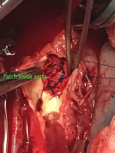 Aortic opening of the fistula closed with a Dacron patch.