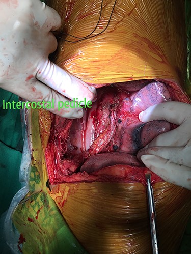 Vascularized intercostal pedicle harvested to re-enforce the primary closure of the esophageal opening of the fistula.