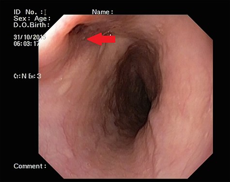UGI endoscopy showing a large depressed ulcer located in the middle third of the esophagus; a diverticulum was seen in the lower end of the ulcer (red arrow).