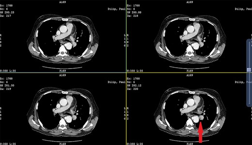 CECT showing the descending thoracic aortic aneurysm; the red arrow shows the communication of the aneurysm with the esophagus.