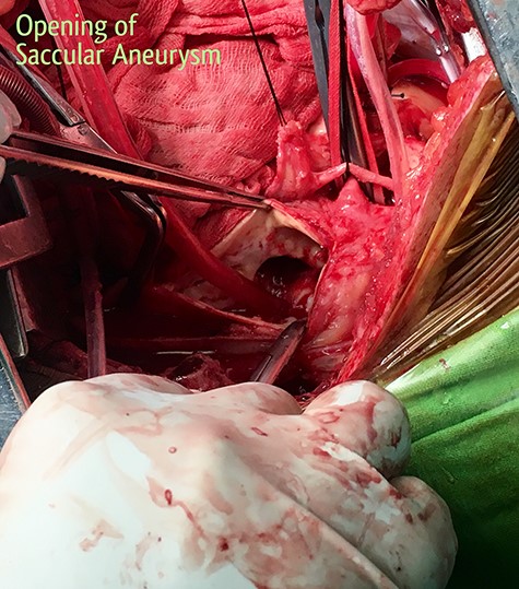 The aneurysm sac opened up.
