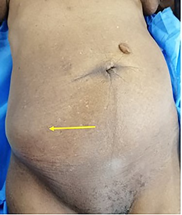 Non-reducible ovoid abdominal mass (arrow) of the right lower quadrant.