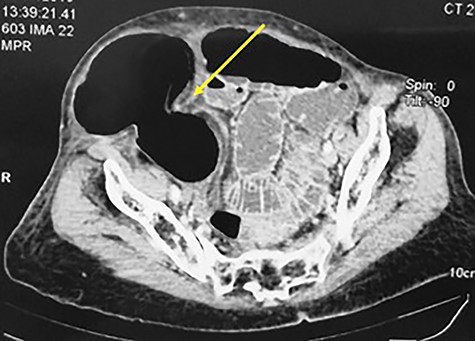 CT scan showing a strangulated right spigelian hernia with hernial ring (arrow) measured at 3.4 cm the coecum as content.