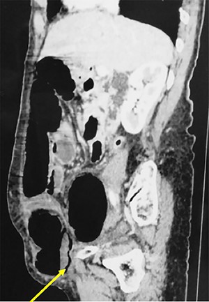 Abdominal CT scan showing a strangulated right spigelian hernia with pneumatosis (arrow).