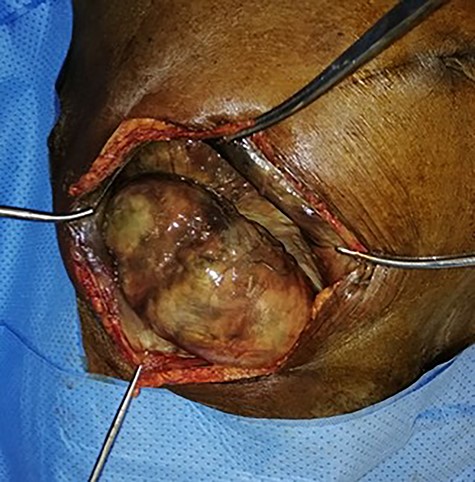 Per operative view of the non-reducible spigelian hernia with necrosis of the sac.