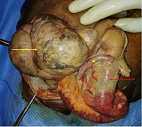 Per operative view of the contents with necrosis of the cecum (yellow arrow), appendix (star) and the terminal ileum (red arrow).