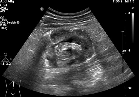 Ultrasonography with a circular concentric layer highly suspicious of invagination.