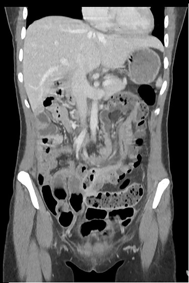 CT scan with long ileocolonic intussusception of the ascending colon into the transverse colon, with possible involvement of the terminal ileum, coronal plane.