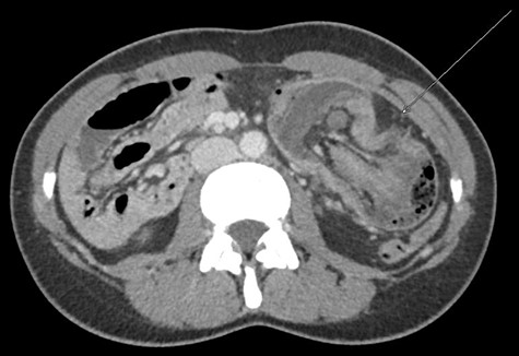 CT scan with long ileocolonic intussusception of the ascending colon into the transverse colon, with possible involvement of the terminal ileum, axial plane (white arrow).