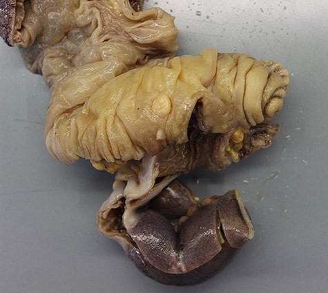 Ileocolic specimen with endometriosis node as the cause of the intussusception.