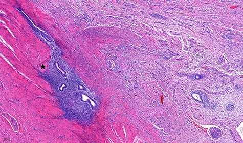 Histological specimen of the endometriosis (scale 200 μm). In detail the outer layer of the muscular bowel wall and adjacent subserosal tissue with fibrosis; embedded there are islands of inconspicuous endometrial-type glands and stroma (black star) with banal cytology.