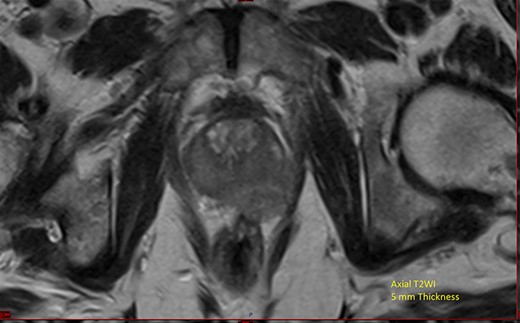 MRI of the prostate.