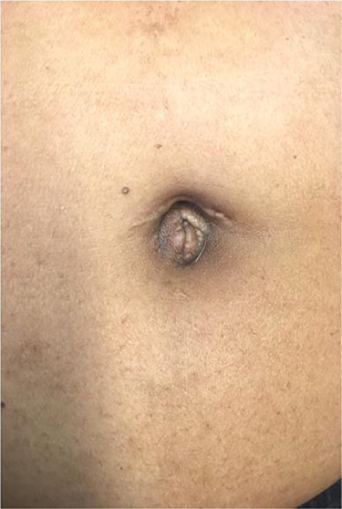 The umbilicus without erythema or induration, note the scare from previous umbilical hernia repair.