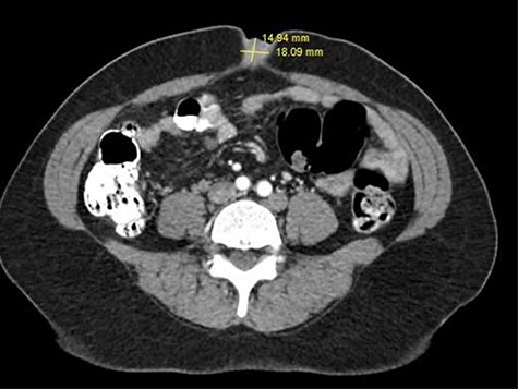 Umbilical mass seen on CT scan.