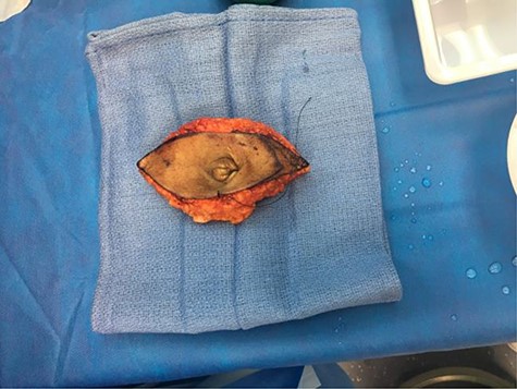 Excised umbilical mass.