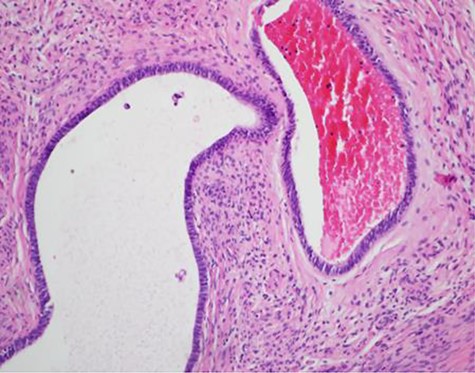 Pathology slide from umbilical endometriosis.