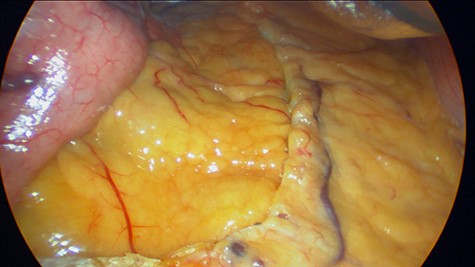 Surgery during gastric sleeve, no lymph nodes are found.