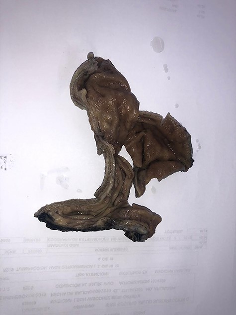 Gastric specimen.