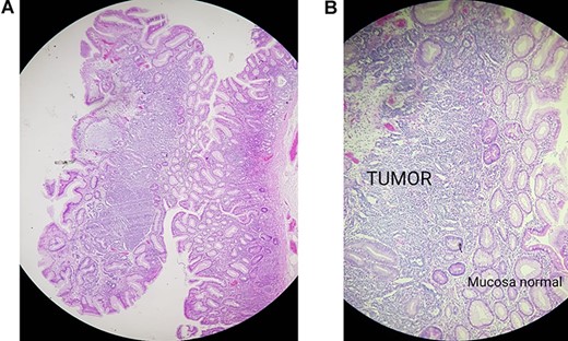 (A) Pathology, gastric mucosa, (B) pathology, tumor invading the gastric muscle.