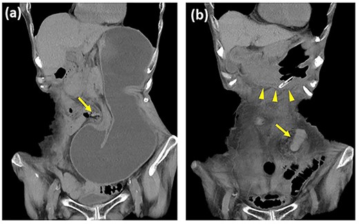 Contrast-enhanced computed tomography images of the gastric internal hernia. (a) The stomach is incarcerated through the lateral defect of the lifted sigmoid colostomy (arrow). (b) The stomach (arrowhead) is reduced after nasogastric tube decompression.