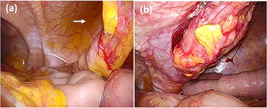 Intraoperative findings of hernia repair. (a) The gastric incarceration is not evident in the lateral space of the sigmoid colostomy (arrow) at the time of exploration. (b) The colostomy is reestablished through an extraperitoneal route using the same stoma site.