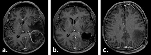 Gadolinium-enhanced T1-weighted axial MRI of the patient preoperatively (a) and 1 day after the tumour resection (b, c).
