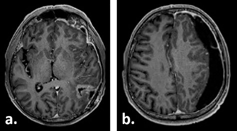 Gadolinium-enhanced T1-weighted axial MRI of the patient 10 weeks after tumour resection demonstrating the resection cavity (a) and new subdural fluid collection (b).