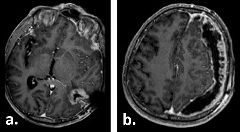 Gadolinium-enhanced T1-weighted axial MRI of the patient 16 weeks after tumour resection demonstrating the resection cavity (a) and progressive subdural fluid collection with the newly occurred contrast-enhancing membrane (b).