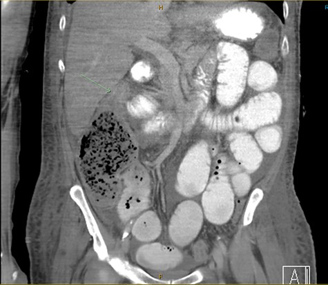 CT demonstrated a thickened caecal wall with pericaecal fat stranding; gastrografin had only passed through small bowel with a transition point identified in his ascending colon secondary to a suspected stercolith.