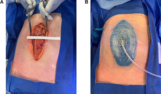 Given the distended loops of bowel, tight abdominal wall and loss of domain, and plan for relook, the decision was made for temporary abdominal closure with the ABTHERA ADVANCE™ Open Abdomen Dressing.