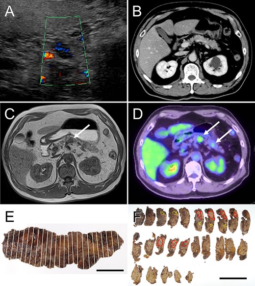 Radiological features and macroscopic findings of Case 1. (A) Abdominal ultrasonography: hypoechoic mass was demonstrated in the pancreas. (B) CT: no mass lesion was detected. (C) MRI: T1-weighted image showed nodular mass of low intensity (white arrow). (D) FDG-PET: two nodular masses with high SUV were detected in the pancreas (white arrows). (E) The macroscopic appearance of the resected pancreas. (F) Two nodular lesions (red circles) and foci of small lesions (yellow circles) were determined by histological examination on the cut surface.