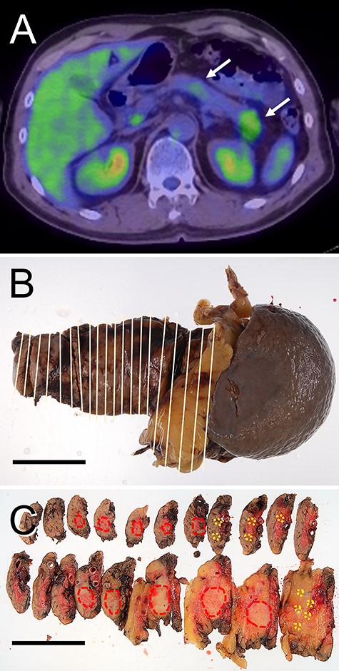 Radiological features and macroscopic findings of Case 2. (A) FDG-PET: two nodular masses with high SUV were detected in the pancreas (white arrows). (B) Macroscopic finding of the resected pancreas. (C) Two nodular lesions (red circles) and foci of small lesions (yellow circles) were indicated on the cut surface.
