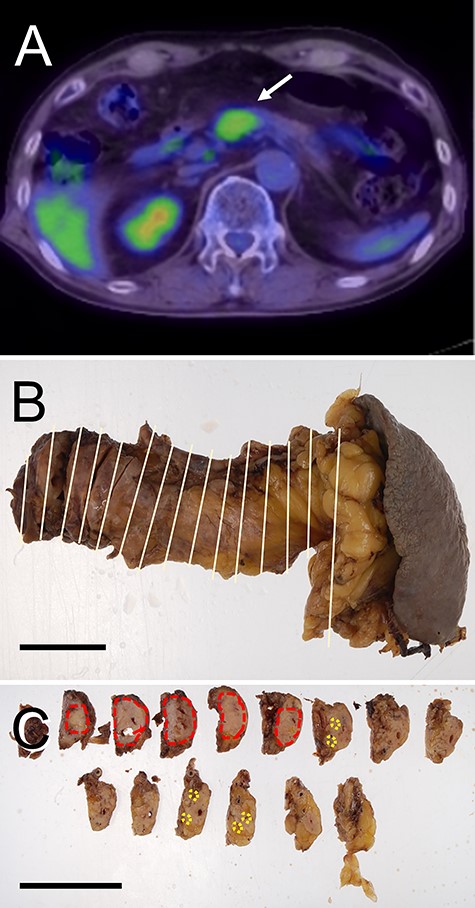 Radiological features and macroscopic findings of Case 3. (A) FDG-PET. (B) Macroscopic finding of the pancreas. (C) A nodular lesion (red circles) and foci small lesions (yellow circles) were indicated on the cut surface.