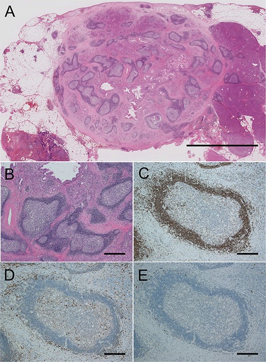 Histological findings of the pancreas in Case 1. (A) Loupe image of the large lesion of the tail. Scale bar, 1 cm. (B) High magnification of the lesion. Magnification, ×20; scale bar, 500 μm. (C) Immunostaining of Bcl-2 was negative in irregular germinal centers. (D) Many IgG-positive plasma cells could be seen. (E) IgG4-positive plasma cells were rarely seen. (D and E, ×100 magnification; scale bars 100 μm).