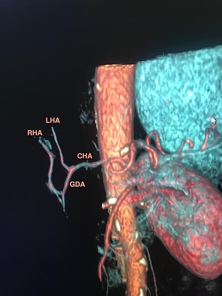 CT-based coronal 3D reconstruction shows the GDA runs down towards the pancreatic mass and the RHA arises from de GDA before entering the pancreas head.