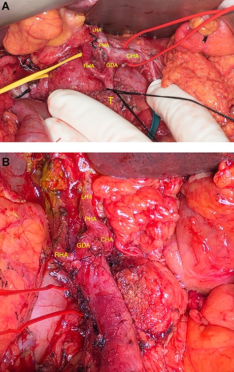 (A) Arterial anatomy before resection. (B) Arterial anatomy after resection.
