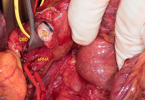 aRHA below the cystic duct (CD), encircled by the vessel loop, arising from the SMA; RHA was identified in the posterolateral aspect of the CBD.