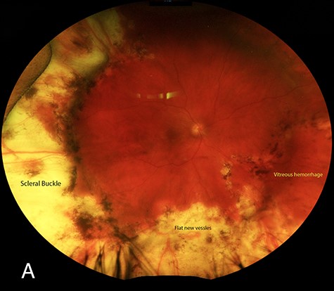 Fundus photograph of the right eye. ScleraI indentation is present secondary to the buckling element. An area of retinal NVE is present close to 6 o’clock.