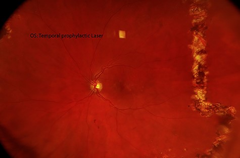 Fundus photograph of the left eye. Laser prophylactic photocoagulation for retinal holes.