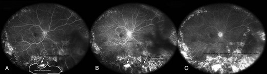 (A) Area of NVE with hyper fluorescence with large area of capillary non-perfusion noted anterior to the retinal NVE. (B) A second discrete area at 5 o’clock that exhibits hyper fluorescence consistent with retinal NVE (red arrow). (C) At 4:44, the aforementioned area has diffuse borders which are consistent with leakage and suspicious for NVE (white arrow). The second area at 5 o’clock also presents increase in continued late leakage with hyper fluorescence consistent with leakage (red arrow).