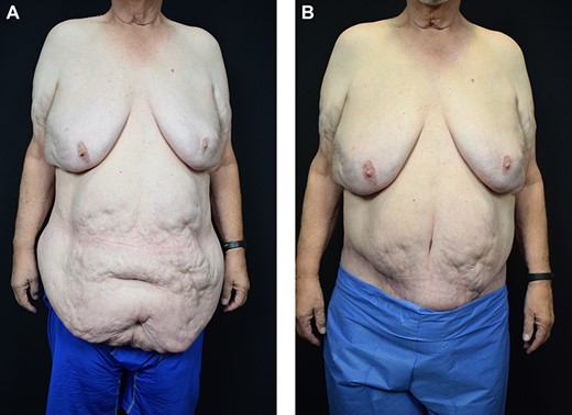 The patient anterior–posterior view before and after surgery.