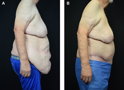 The patient lateral view before and after surgery.