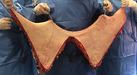 The removed tissue specimen after surgery (9.480 kg).