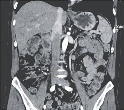 CT, during arterial embolization, the spleen is normal.