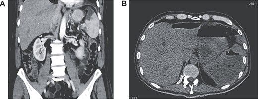 (A) Contrast-enhanced CT showing splenic infarction with inflammatory changes; (B) CT showing free liquid with a hypodense lesion.