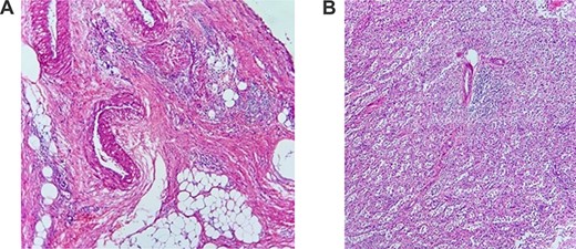 (A) Pathology of the spleen with heavy inflammatory infiltrate; (B) pathology of the spleen with necrosis.