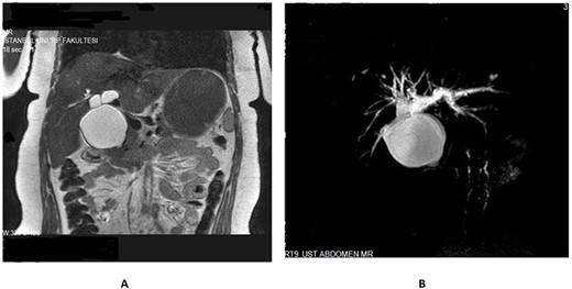 (A) MRI and (B) MRCP showing cystic dilatation of the common bile duct with intrahepatic extension (type Ic).