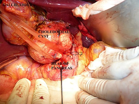 Open view of the choledochal cyst after removal of gallbladder from liver bed. Distal part of cyst noted to be normal as it enters the head of pancreas (arrow).