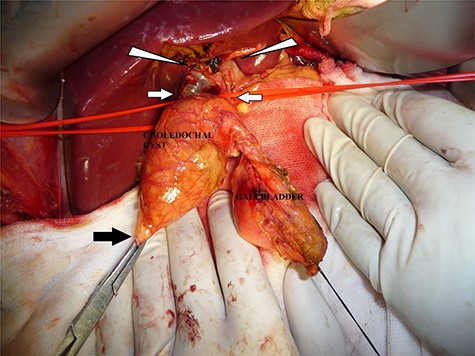 Proximal hilar dissection showing double ducts (white arrows) originating from the hilar confluence of left and right hepatic ducts (arrow head). Distal part of cyst transected from head of pancreas (black arrow).